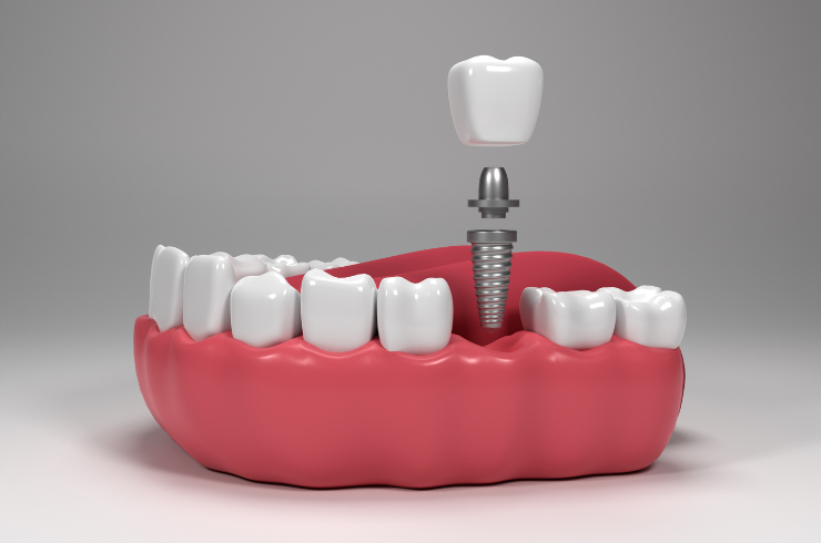 dental implants